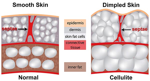 cellulite-definition-141 - מועדון המטפלים הישראלי